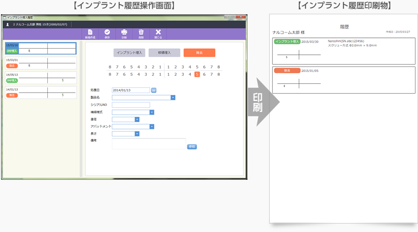 インプラント履歴