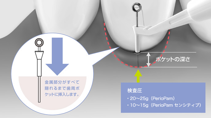 正確に歯周検査ができる