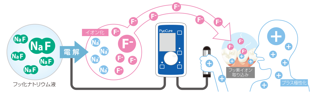 フッ素イオン導入法の仕組み