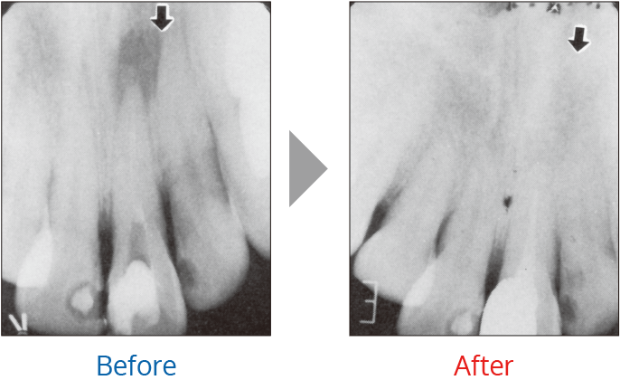 根管治療での治療例1
