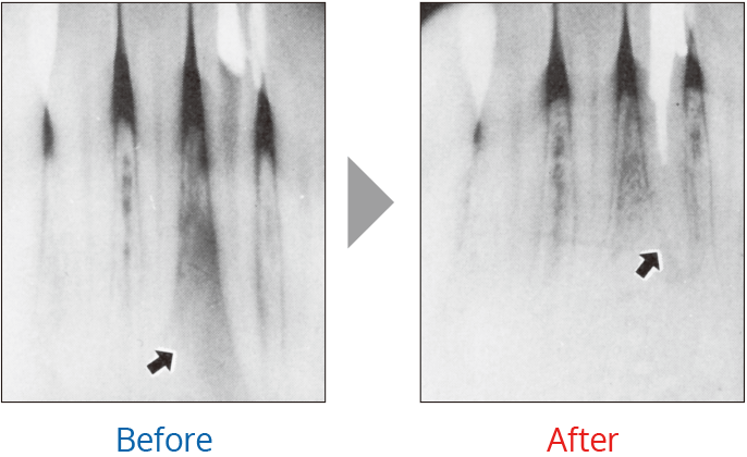 根管治療での治療例2