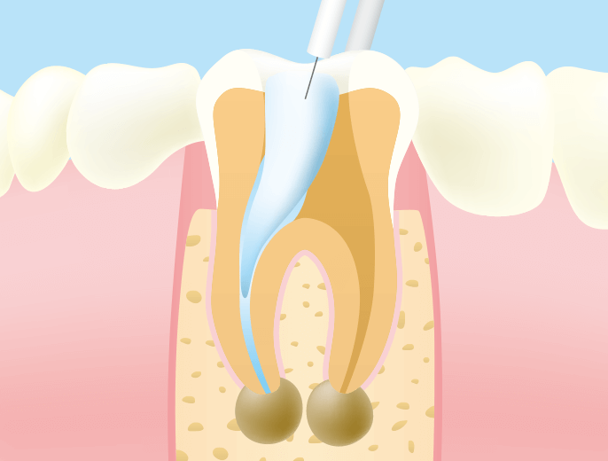 根管治療用アタッチメントの針を綿栓に挿入しクランプを唇に挟み固定します。