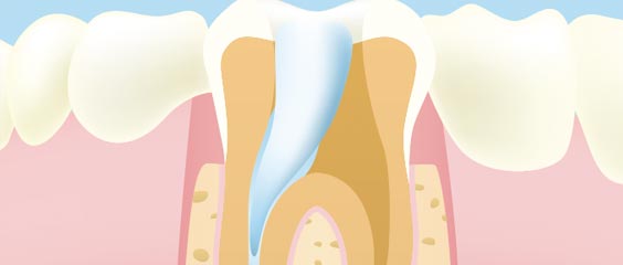 根管治療での活用法