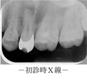 初診時X線