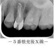 5番根充後X線
